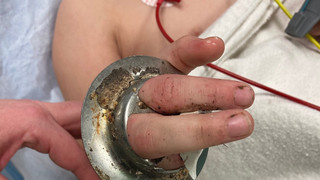 Rettung in Wiesbaden: Kinderfinger stecken in Abfluss-Sieb fest