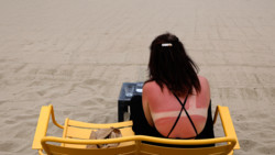 Likes für Sonnenbrand