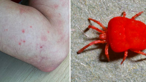 Grasmilben: Was juckt da auf der Wiese?