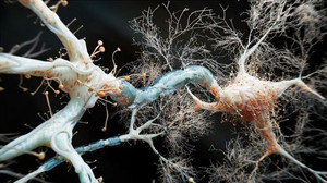 Häufig mit Alzheimer verwechselt: Jeder Zehnte über 65 leidet eigentlich an LATE