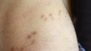 Skabies-Milbe: Zahl der Krätze-Fälle in Hersfeld-Rotenburg nimmt zu