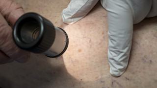 AOK zu Hautkrebs in Hessen: Werra-Meißner-Kreis stärker betroffen