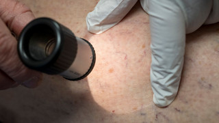 Schwarzer Hautkrebs in Hessen und Rheinland-Pfalz am häufigsten