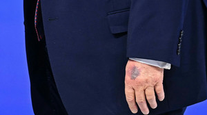 Bluterguss nährt neue Spekulationen über Trumps Gesundheit