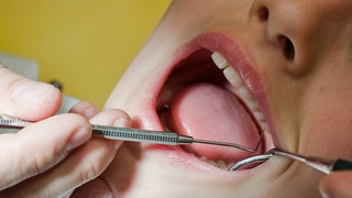 Zahnzusatzversicherung: Lohnt es sich für mich?