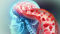 Sieben Tage nach Infekt sind wir in der Schlaganfall-Zone