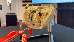 «Ich wollte mein Herz behalten»: Frau bekommt eigenes plastiniertes Organ 